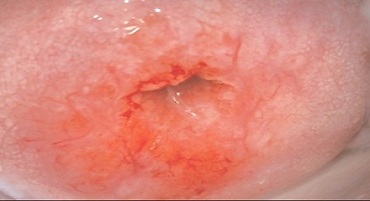 Эрозия шейки матки