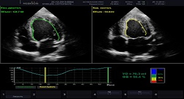 Що покаже УЗД серця