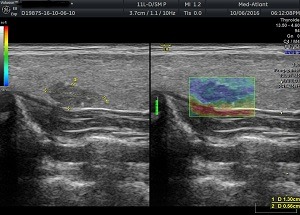 зробити еластографію
