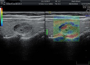 Еластографія в Медатлант