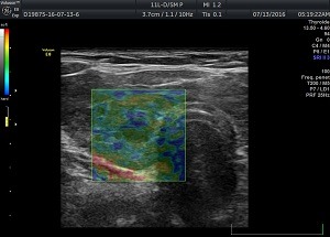 Еластографія